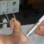 shockwave therapy for plantar fasciitis treatment