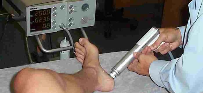 shockwave therapy for plantar fasciitis treatment